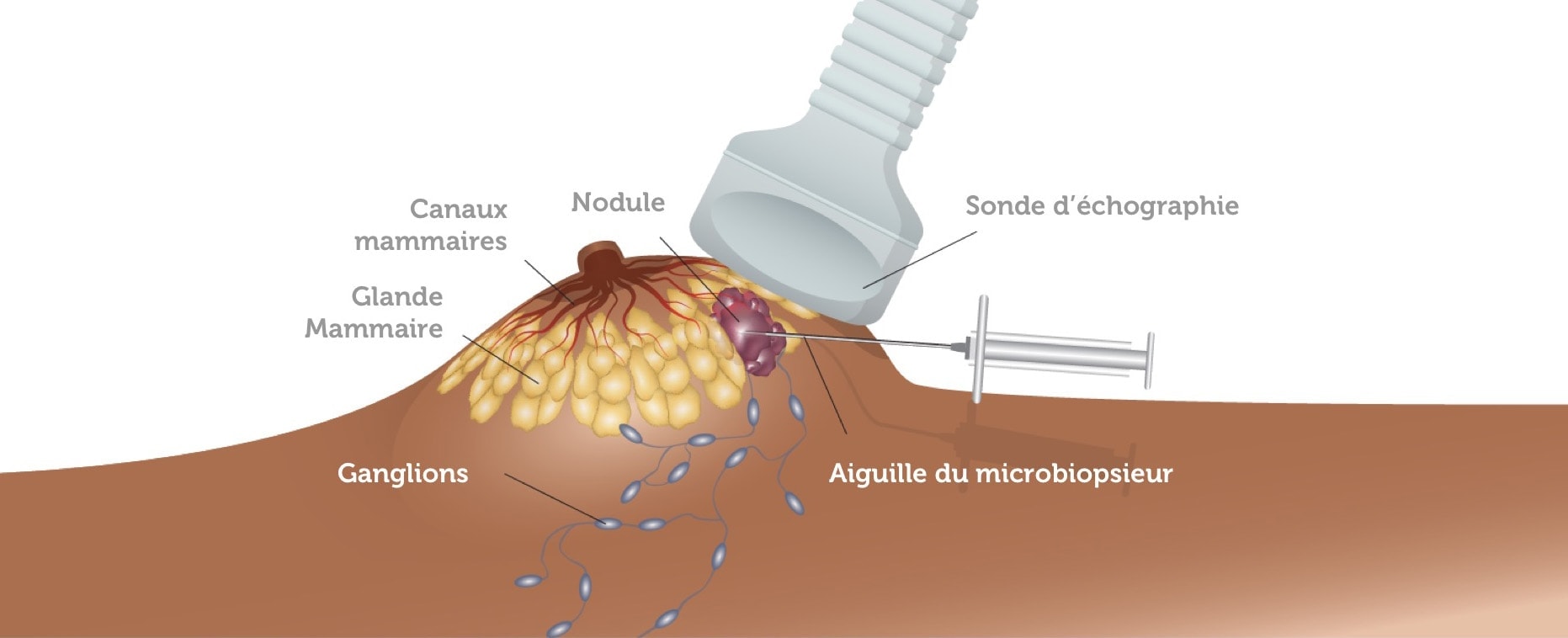 Pourquoi une biopsie mammaire ?