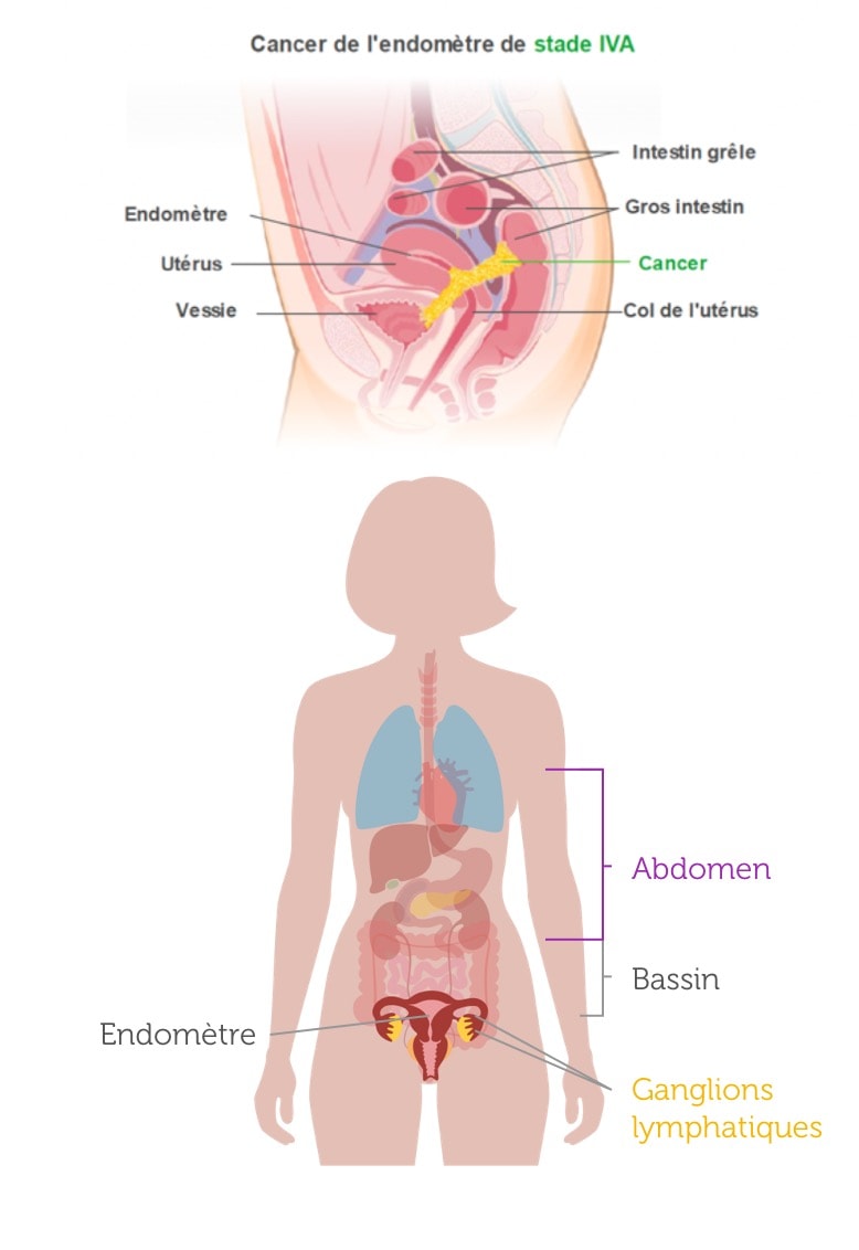 Quelles sont les métastases les plus fréquentes dans un cancer de l’endomètre avancé ?